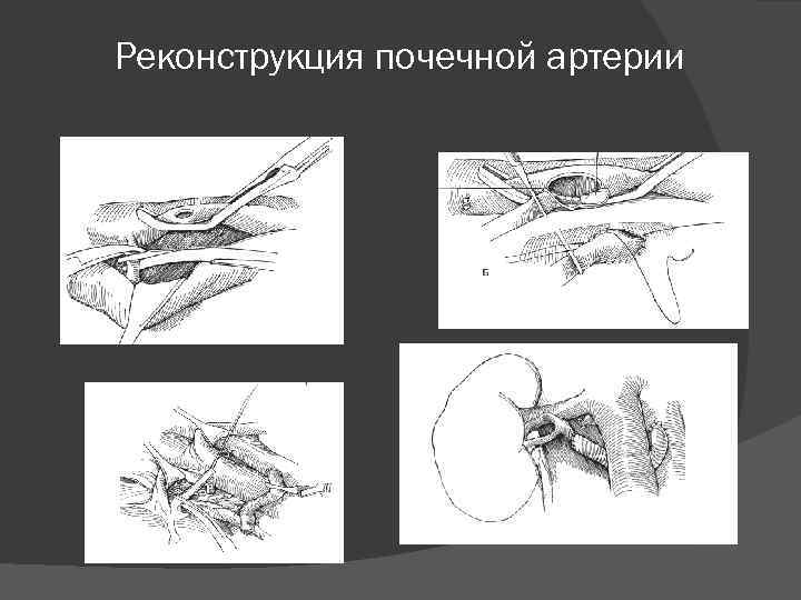 Реконструкция почечной артерии 