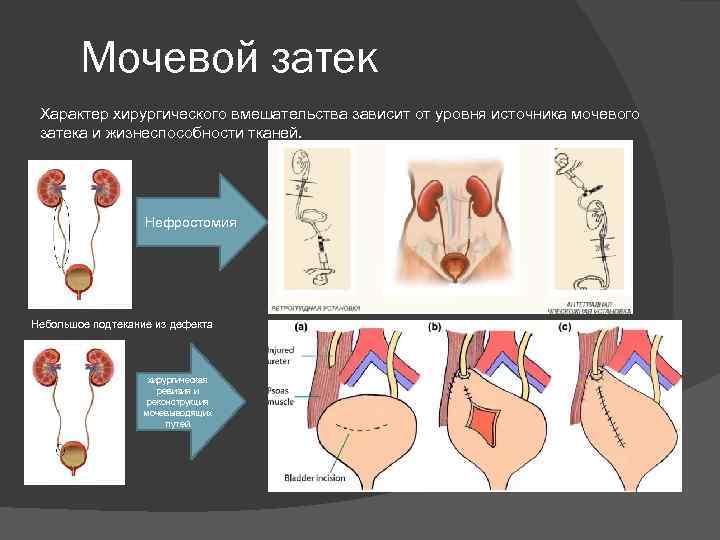 Мочевой затек Характер хирургического вмешательства зависит от уровня источника мочевого затека и жизнеспособности тканей.