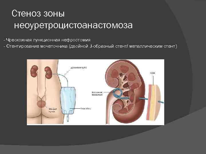 Пункционная нефростомия