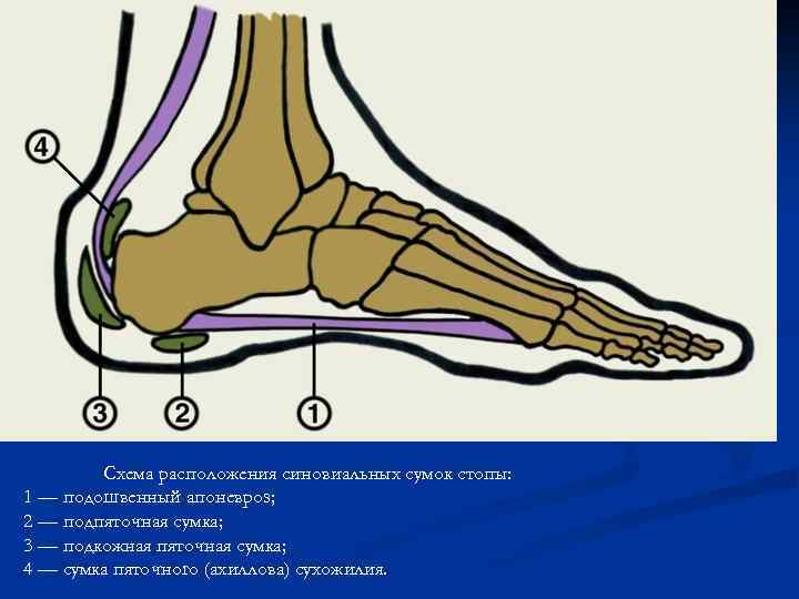 Схема расположения синовиальных сумок стопы: 1 — подошвенный апоневроз; 2 — подпяточная сумка; 3
