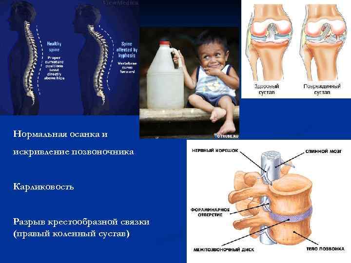 Нормальная осанка и искривление позвоночника Карликовость Разрыв крестообразной связки (правый коленный сустав) 