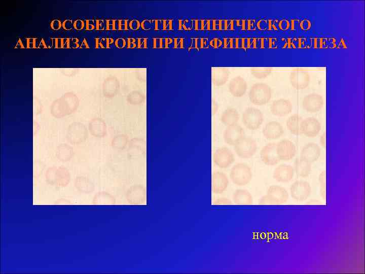 ОСОБЕННОСТИ КЛИНИЧЕСКОГО АНАЛИЗА КРОВИ ПРИ ДЕФИЦИТЕ ЖЕЛЕЗА норма 