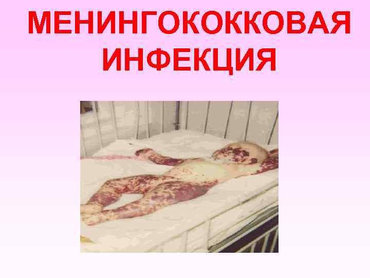МЕНИНГОКОККОВАЯ ИНФЕКЦИЯ 