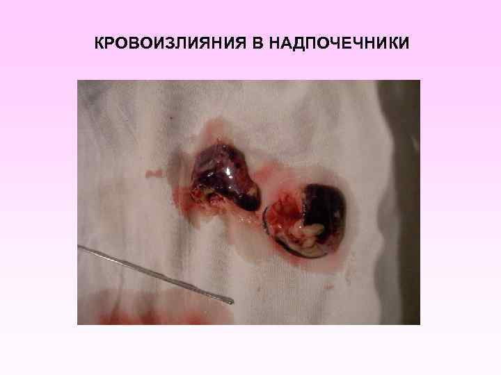 КРОВОИЗЛИЯНИЯ В НАДПОЧЕЧНИКИ 