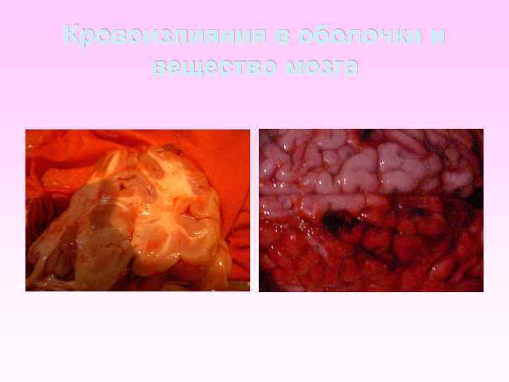 Кровоизлияния в оболочки и вещество мозга 