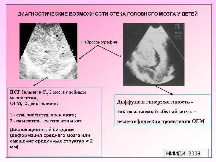 ДИАГНОСТИЧЕСКИЕ ВОЗМОЖНОСТИ ОТЕКА ГОЛОВНОГО МОЗГА У ДЕТЕЙ Нейросонография НСГ больного С. , 2 мес.