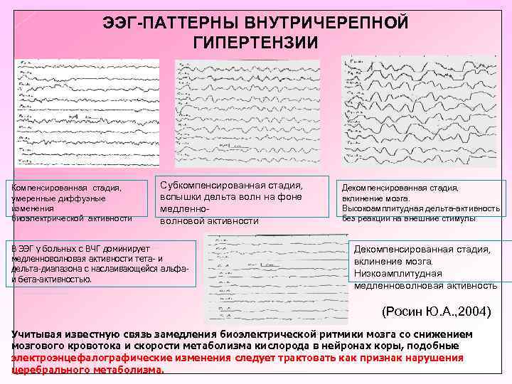 ЭЭГ-ПАТТЕРНЫ ВНУТРИЧЕРЕПНОЙ ГИПЕРТЕНЗИИ Компенсированная стадия, умеренные диффузные изменения биоэлектрической активности Субкомпенсированная стадия, вспышки дельта