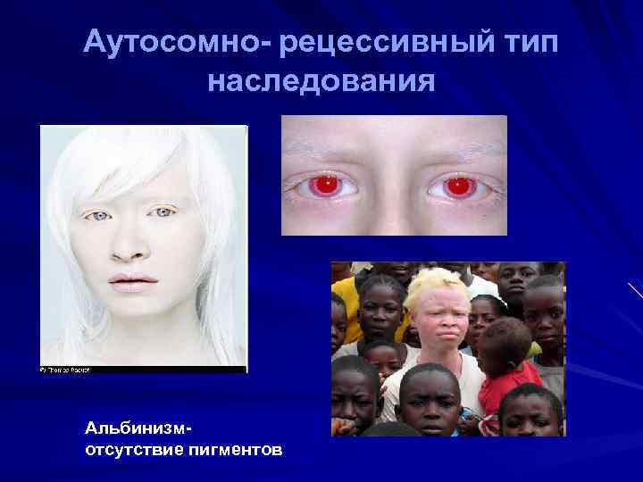 Аутосомно- рецессивный тип наследования Альбинизмотсутствие пигментов 