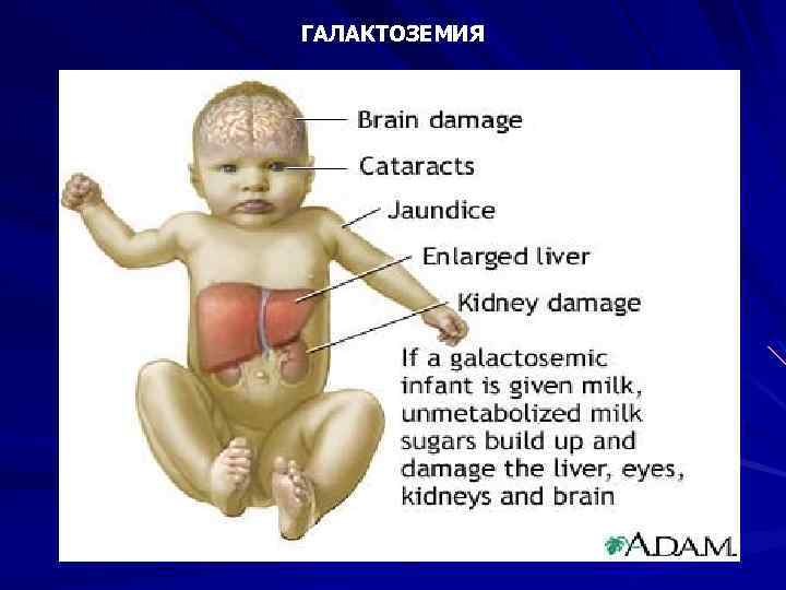 ГАЛАКТОЗЕМИЯ 