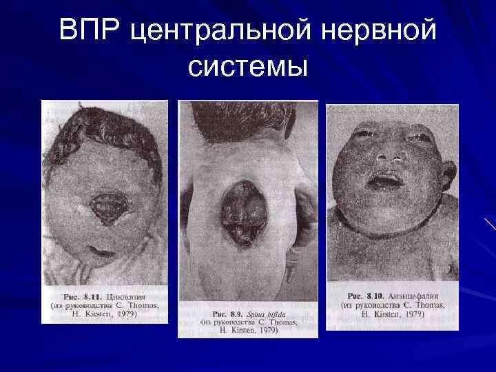 ВПР центральной нервной системы 