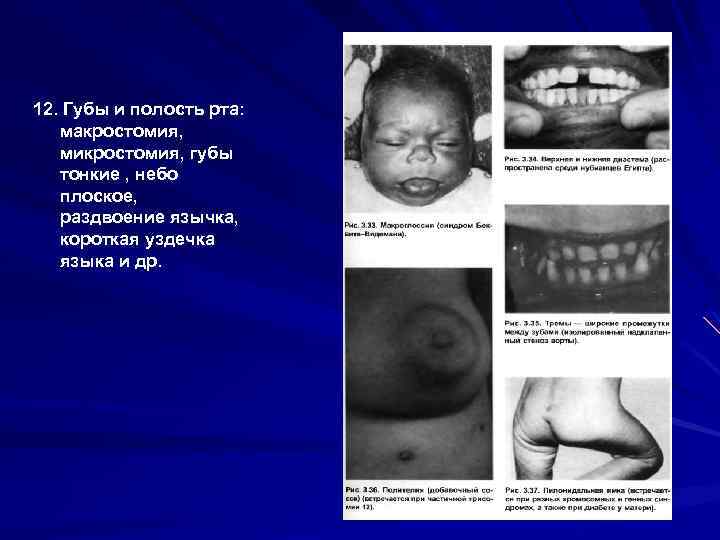 12. Губы и полость рта: макростомия, микростомия, губы тонкие , небо плоское, раздвоение язычка,