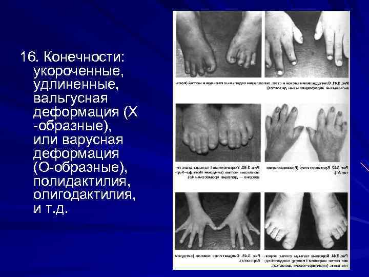 16. Конечности: укороченные, удлиненные, вальгусная деформация (Х -образные), или варусная деформация (О-образные), полидактилия, олигодактилия,