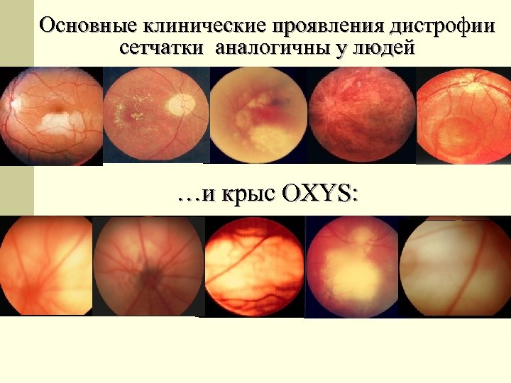 Основные клинические проявления дистрофии сетчатки аналогичны у людей …и крыс OXYS: 