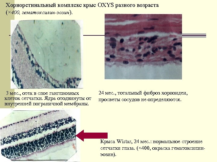 Хориоретинальный комплекс крыс OXYS разного возраста (× 400, гематоксилин-эозин). 3 мес. , отек в