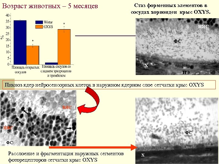 Возраст животных – 5 месяцев Стаз форменных элементов в сосудах хориоидеи крыс OXYS. НЯС