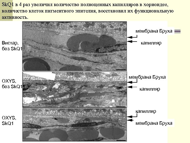 Sk. Q 1 в 4 раз увеличил количество полноценных капилляров в хориоидее, количество клеток