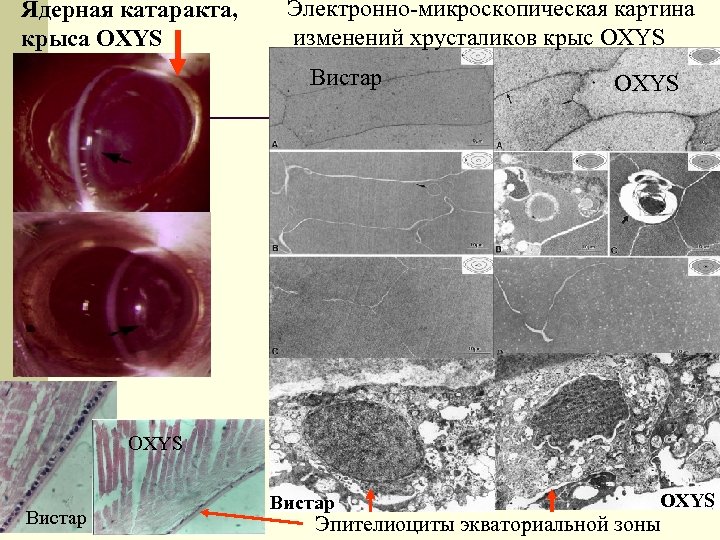 Ядерная катаракта, крыса OXYS Электронно-микроскопическая картина изменений хрусталиков крыс OXYS Вистар OXYS Эпителиоциты экваториальной