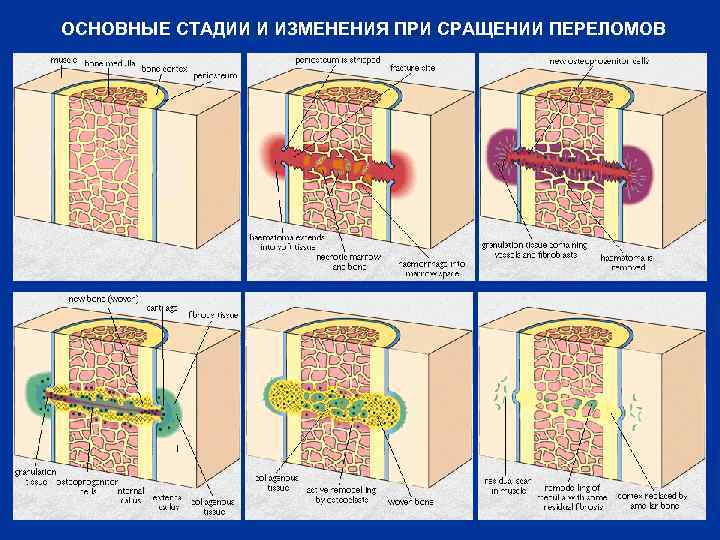 ОСНОВНЫЕ СТАДИИ И ИЗМЕНЕНИЯ ПРИ СРАЩЕНИИ ПЕРЕЛОМОВ 