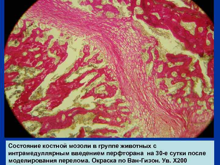 Состояние костной мозоли в группе животных с интрамедуллярным введением перфторана на 30 -е сутки