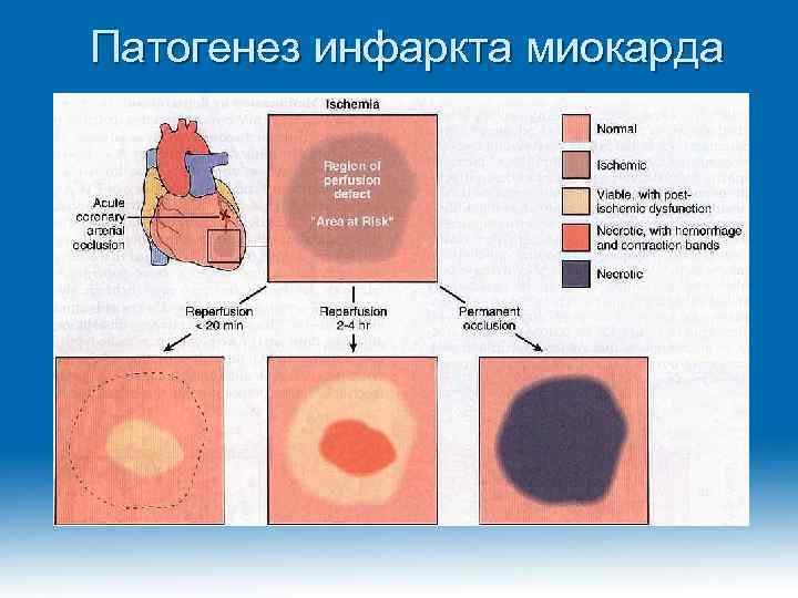 Патогенез инфаркта миокарда 