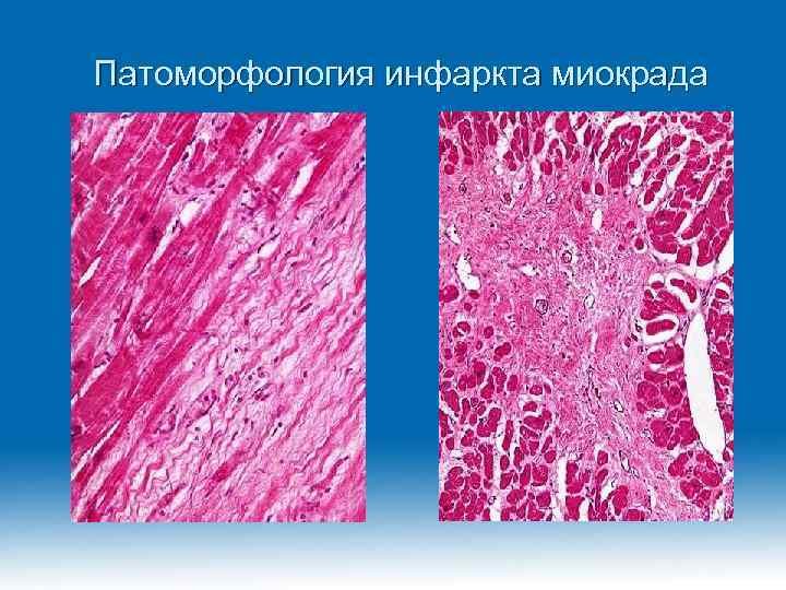 Патоморфология инфаркта миокрада 