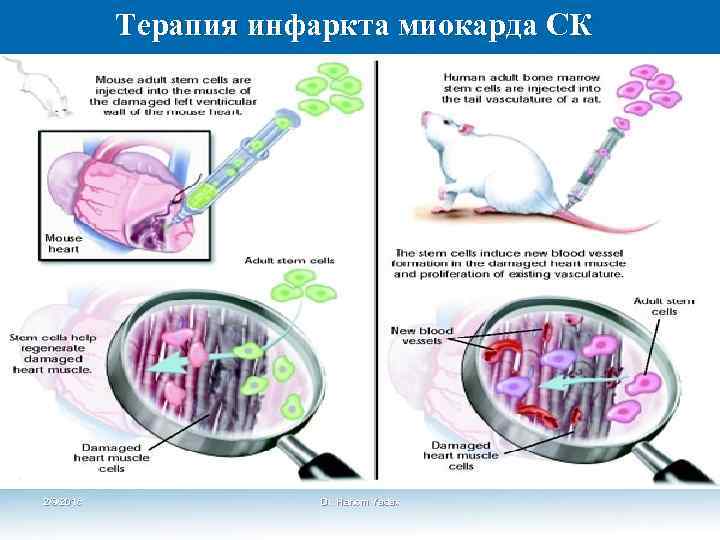 Терапия инфаркта миокарда СК 2/9/2018 Dr. Hariom Yadav 