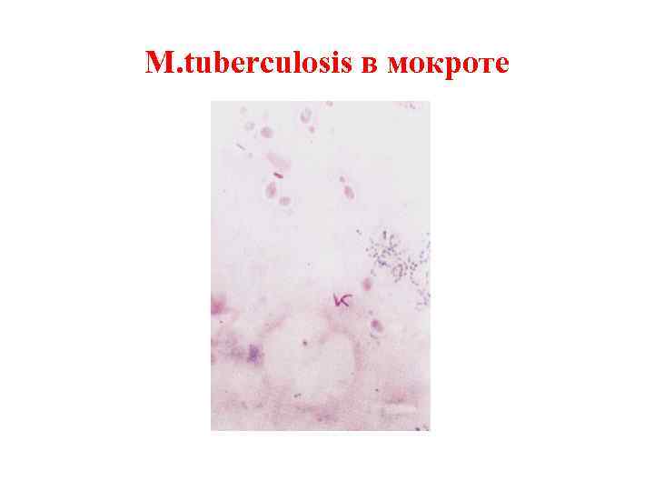 M. tuberculosis в мокроте 