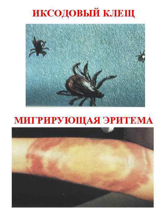 ИКСОДОВЫЙ КЛЕЩ МИГРИРУЮЩАЯ ЭРИТЕМА 