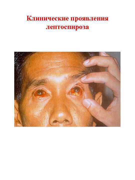 Клинические проявления лептоспироза 
