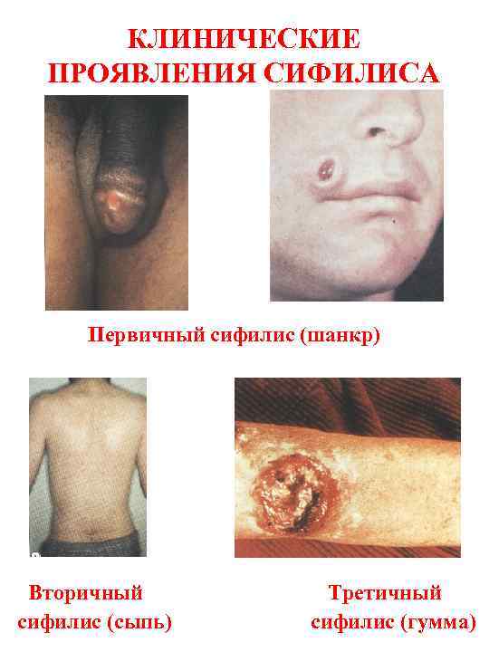 КЛИНИЧЕСКИЕ ПРОЯВЛЕНИЯ СИФИЛИСА Первичный сифилис (шанкр) Вторичный сифилис (сыпь) Третичный сифилис (гумма) 