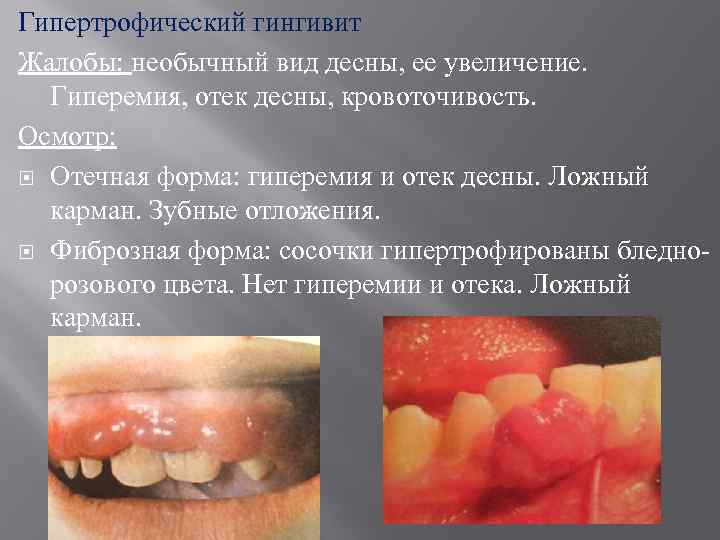 Презентация болезни пародонта