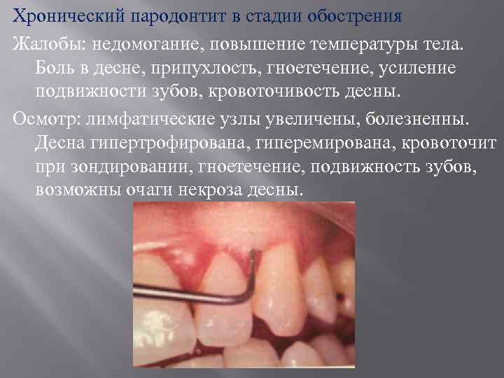 Хронический пародонтит в стадии обострения Жалобы: недомогание, повышение температуры тела. Боль в десне, припухлость,