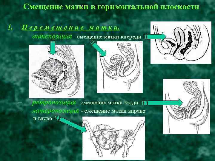 Смещение матки в горизонтальной плоскости 1. П е р е м е щ е