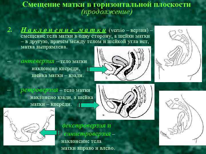 Положение матки. Матка расположена в anteflexio смещена влево. Матка загиб антефлексио. Матка антефлексио при беременности. Матка наклонена кзади.