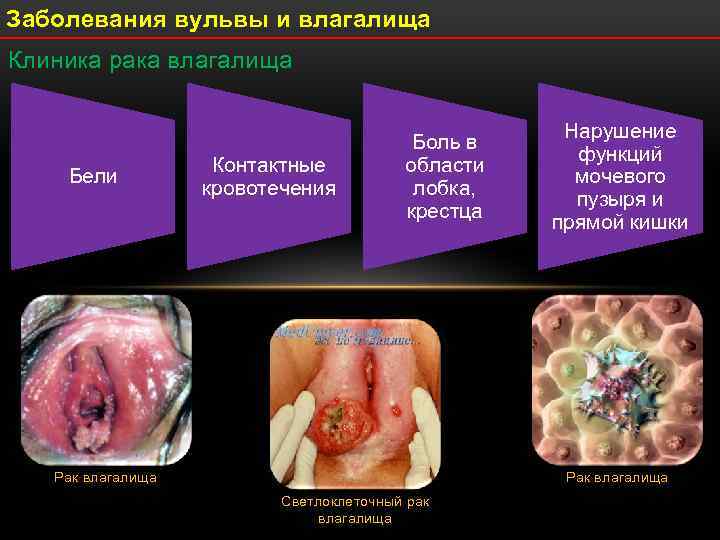 Заболевания вульвы и влагалища Клиника рака влагалища Бели Контактные кровотечения Боль в области лобка,