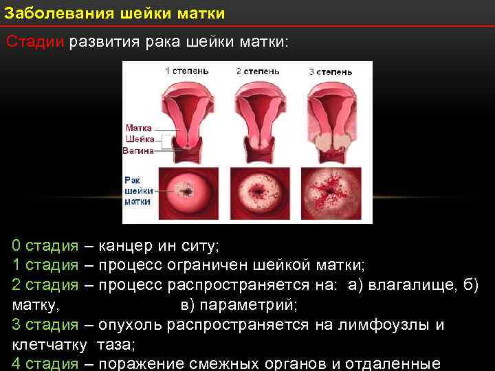 Заболевания шейки матки Стадии развития рака шейки матки: 0 стадия – канцер ин ситу;