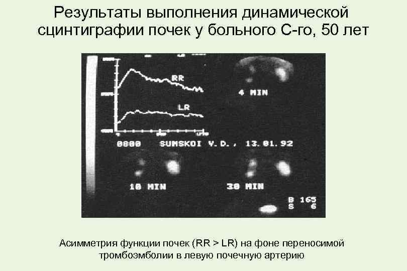 Результаты выполнения динамической сцинтиграфии почек у больного С-го, 50 лет Асимметрия функции почек (RR