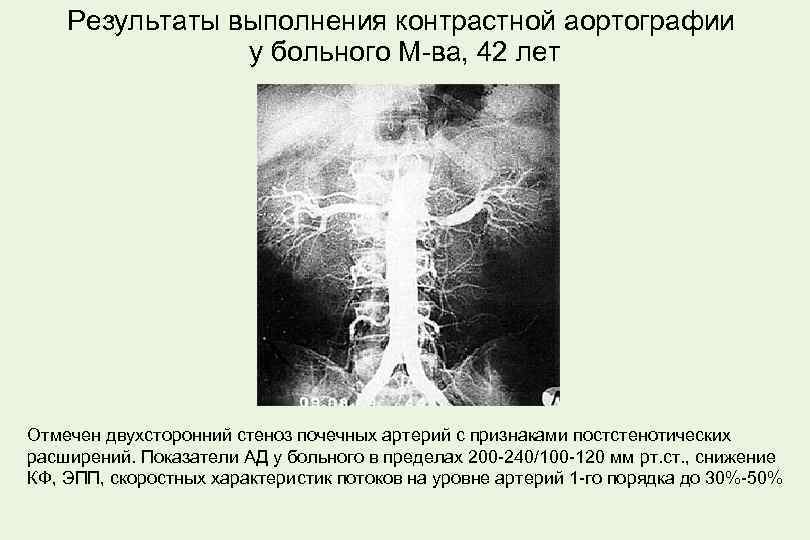 Результаты выполнения контрастной аортографии у больного М-ва, 42 лет Отмечен двухсторонний стеноз почечных артерий