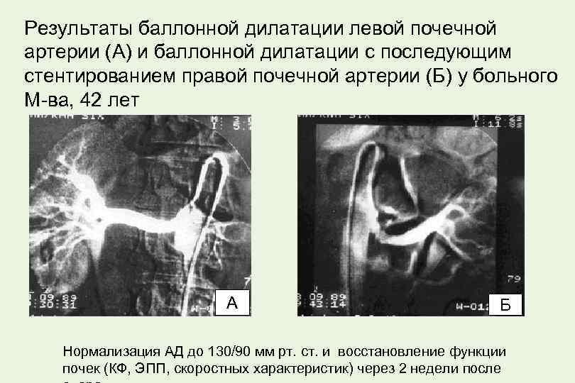 Результаты баллонной дилатации левой почечной артерии (А) и баллонной дилатации с последующим стентированием правой