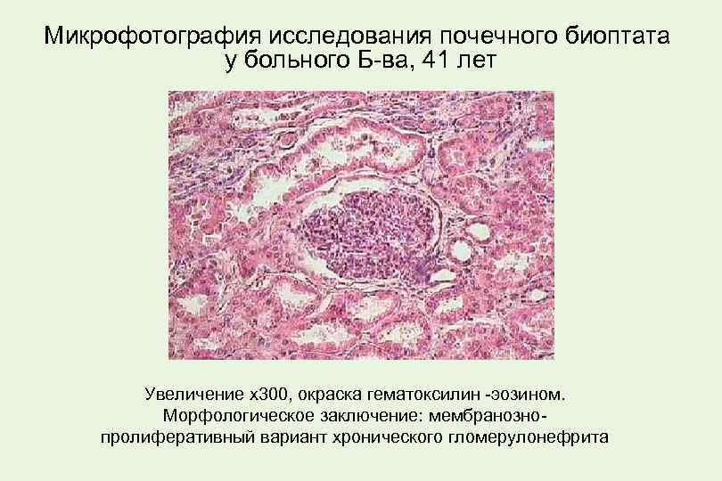 Микрофотография исследования почечного биоптата у больного Б-ва, 41 лет Увеличение х300, окраска гематоксилин -эозином.