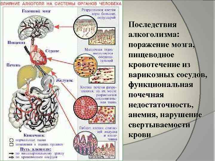 Последствия алкоголизма: поражение мозга, пищеводное кровотечение из варикозных сосудов, функциональная почечная недостаточность, анемия, нарушение