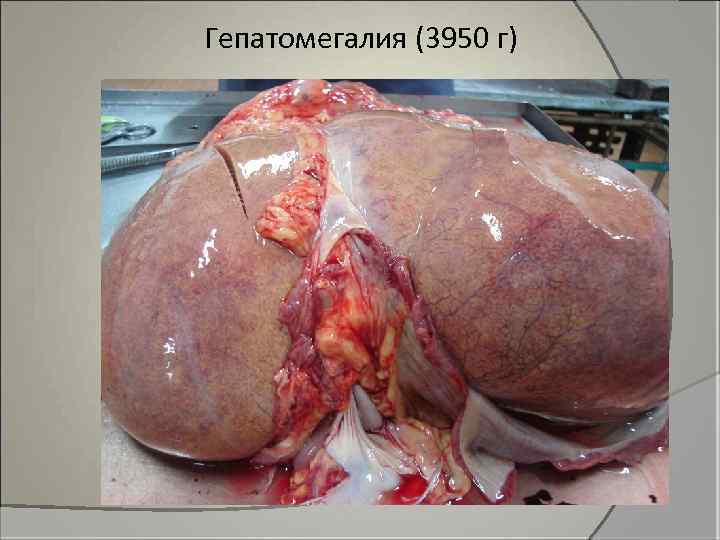 Гепатомегалия (3950 г) 