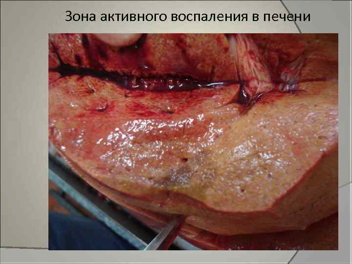 Зона активного воспаления в печени 