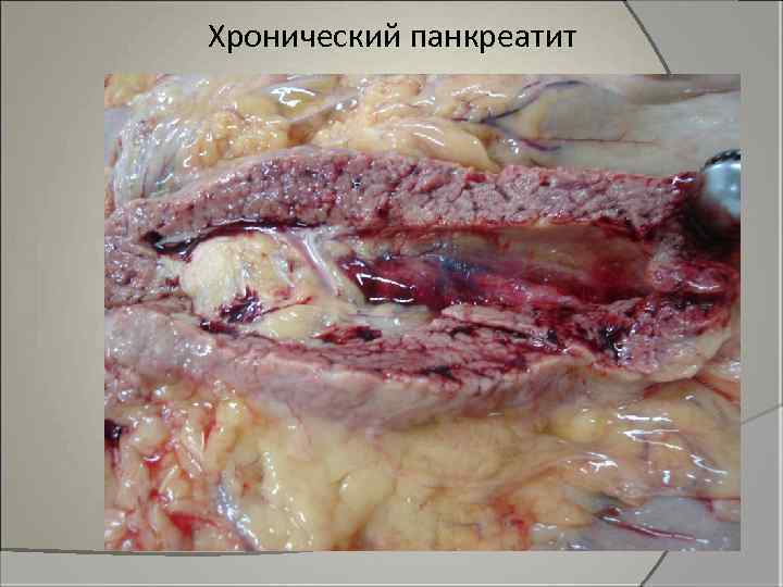 Хронический панкреатит 