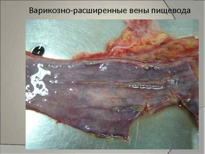 Варикозно-расширенные вены пищевода 