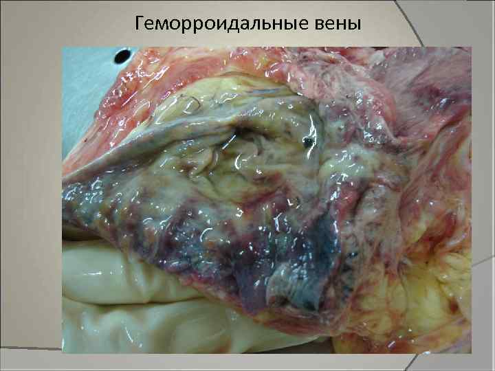 Геморроидальные вены 