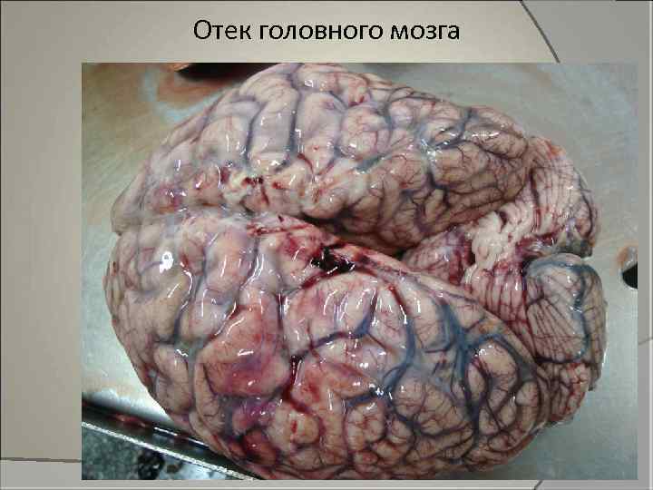 Отек головного мозга 
