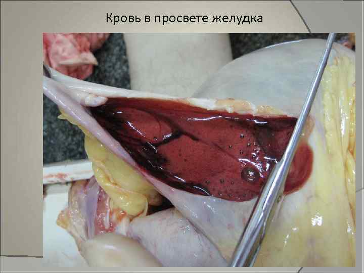 Кровь в просвете желудка 