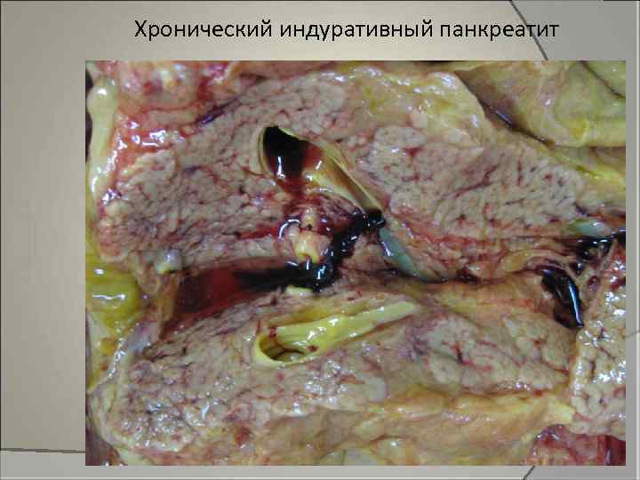 Хронический индуративный панкреатит 