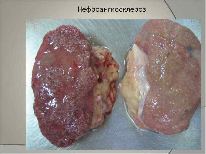 Нефроангиосклероз 